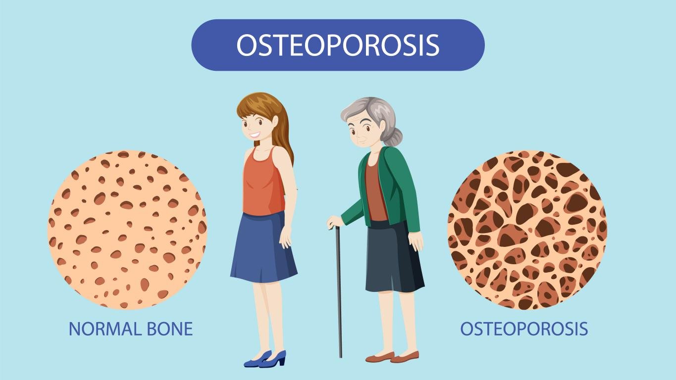 The MVPHA Bone Density Screenings